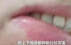 蜈蚣咬伤的正确处理办法，蜈蚣咬伤会不会致命？