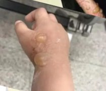 隐翅虫咬人后图片，网友实拍五花八门隐翅虫咬伤后画面