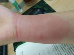 红火蚁咬了红肿痒涂什么药？红火蚁咬伤后图片