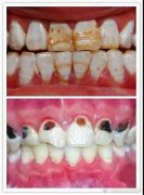 可乐牙图片大全，可乐牙是怎么形成的？