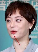 孙俪嘴边的痣怎么来的，是什么痣为什么不去掉？