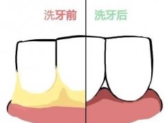 洗牙能把牙洗白吗？为什么洗牙后感觉牙缝变大了呢