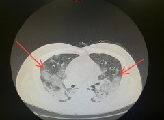 怎么判断肺部感染？肺部感染的症状有哪些症状