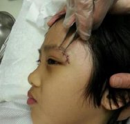 吴费曼当时伤的重吗？看伤口照片吧！