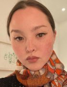 戴文青木是唐氏综合征吗？长得比较像唐氏而已