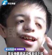 鸟面综合症患者图片？鸟面综合症产检检查的出来吗