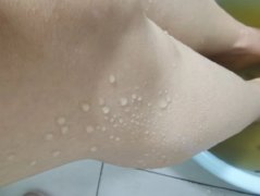 湿气和汗水区别在哪，有什么区别，区分方法来了！