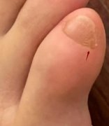 小脚趾指甲分两瓣有什么说法？是纯正的汉人？
