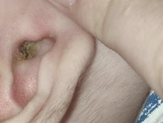 耳屎气味香甜、清香是怎么回事，怎么形成的很特别的味道？