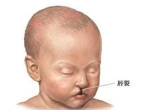 【科学姐】李嫣兔唇这事儿 真不能全怪王菲