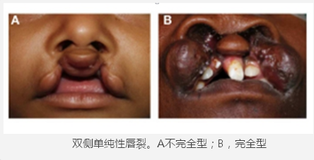 【科学姐】李嫣兔唇这事儿 真不能全怪王菲