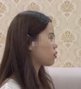 侧颜丑正面好看的原因分析，有什么办法改善？