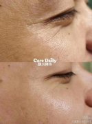 长鱼尾纹是身体哪个器官老化了吗，鱼尾纹是笑出来的吗？