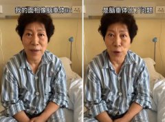 脑垂体瘤的面相是什么样的？手术后面容还能恢复吗？