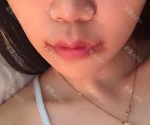 有唇珠的人面相有福吗？唇珠能自己用手捏出来吗？