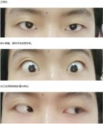 现实中的死鱼眼图片，死鱼眼的人什么性格？