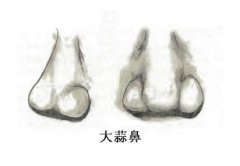 蒜头鼻是不是没有鼻梁？蒜头鼻子的女人面相好吗？