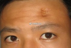 额头有疤真的会命苦吗，额头有疤痕的大人物富豪都有谁？