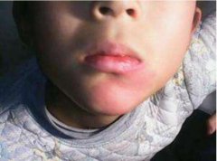 下巴有胎记的命运好吗，胎记都有哪些颜色？