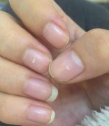 指甲上有白色斑点是怎么回事，指甲上都是竖纹是什么原因