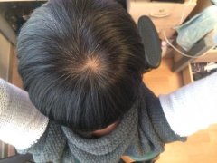 多大年龄有白头发叫少白头，少白头和肾虚有关系吗？